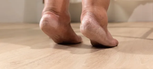 Swollen ankles